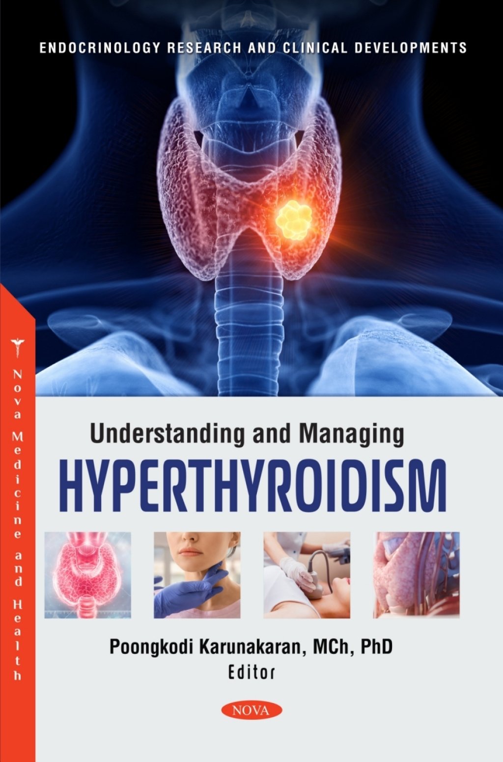 Understanding and Managing Hyperthyroidism (PDF) Understanding and Managing Hyperthyroidism (PDF)