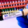 Sexually Transmitted Infections: An Update on the Recognition and Management of Common STI Syndromes (Videos + Slides)