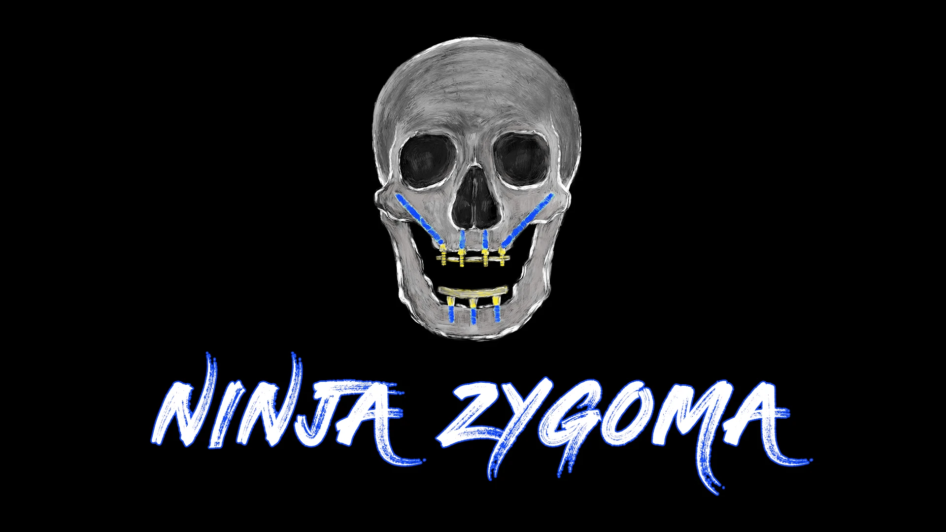 Implant Ninja Ninja Zygoma Implant Ninja Ninja Zygoma