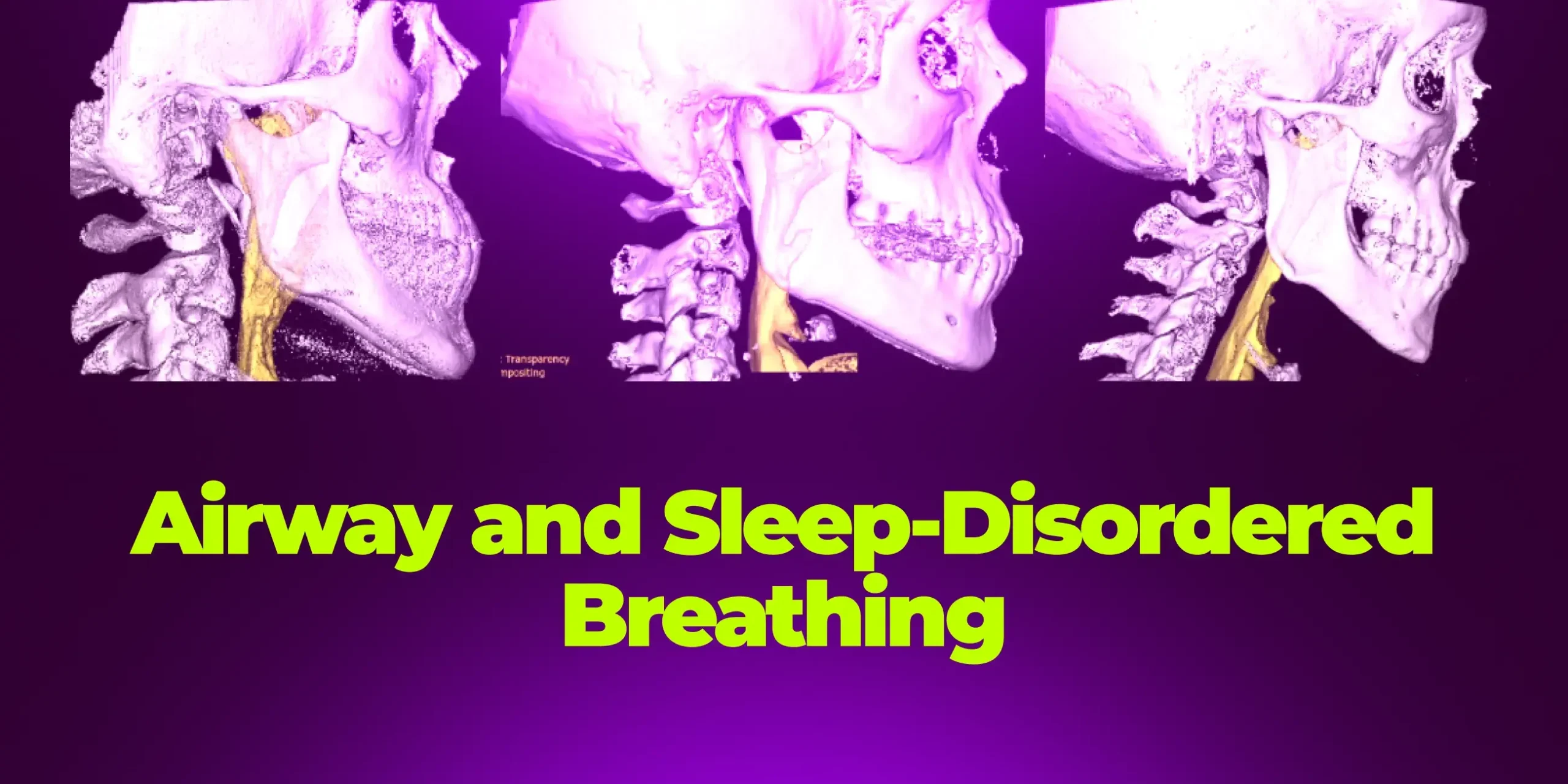OHI-S Airway and Sleep-Disordered Breathing Integrating Myofunctional Protocols OHI-S Airway and Sleep-Disordered Breathing Integrating Myofunctional Protocols