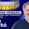 OHI-S Anterior Veneers Smile Design and Treatment Planning by Jan Hajtó