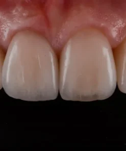 OHI-S Ceramic Veneers Interdisciplinary Approach and Updated Protocols
