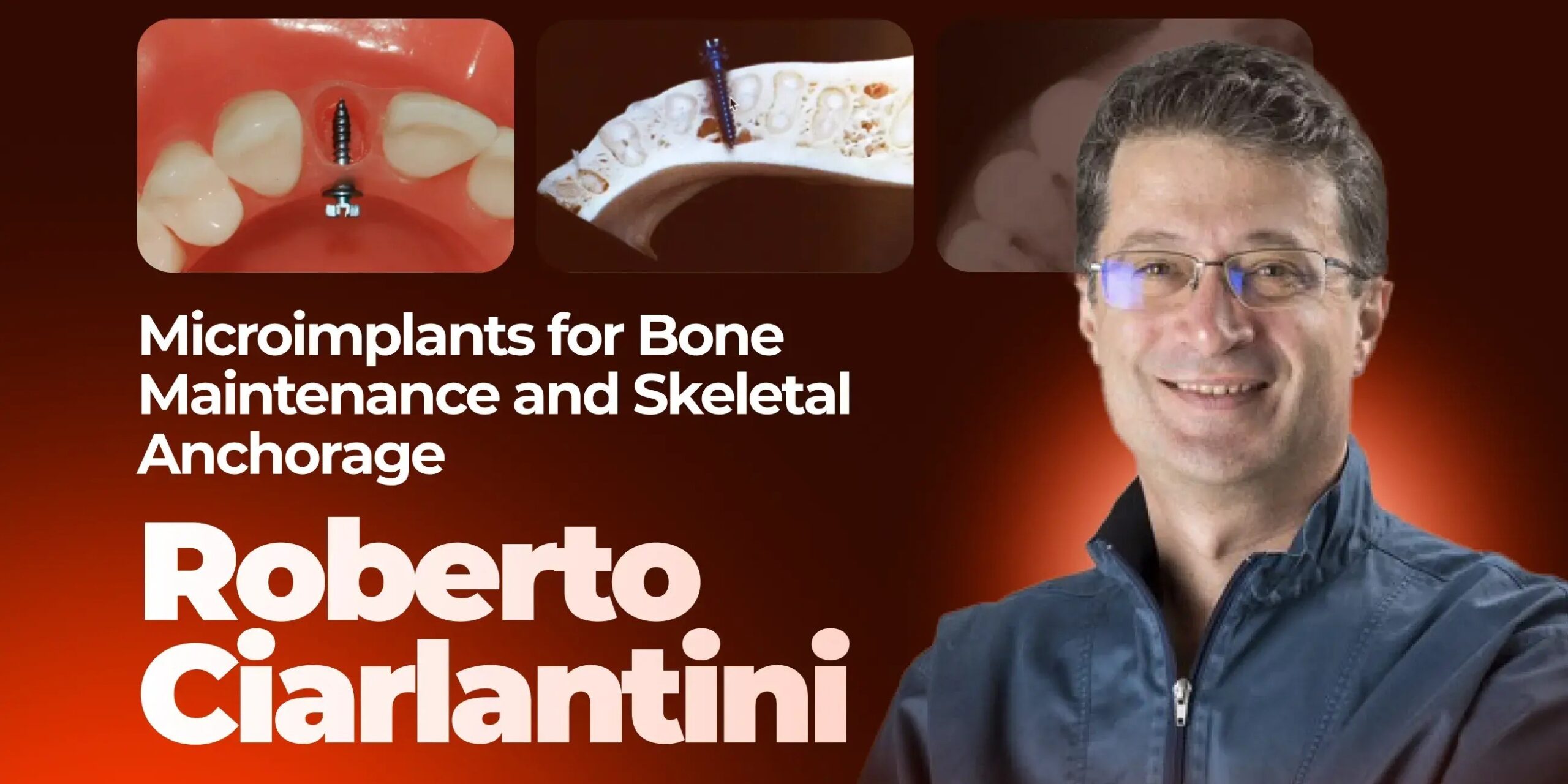 OHI-S Microimplants as Bone Maintainers and Skeletal Anchorage Insertion Protocols OHI-S Microimplants as Bone Maintainers and Skeletal Anchorage Insertion Protocols