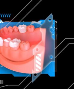 OHI-S Veneers, inlay, onlay, crowns full protocols
