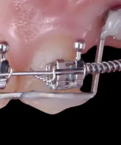 OHI-S Оrthodontic preparation before prosthetics