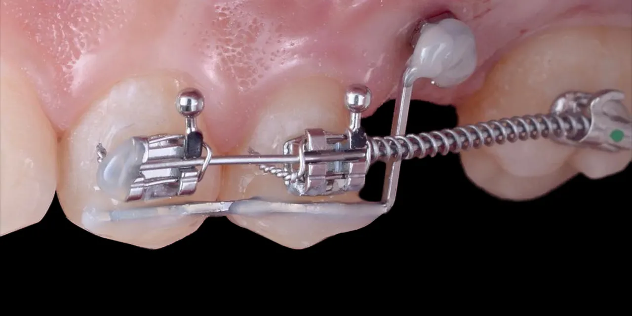 OHI-S Оrthodontic preparation before prosthetics