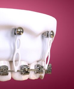 OHI-S Microimplant Anchorage in Clinical Practice Guide for Beginners and Intermediate