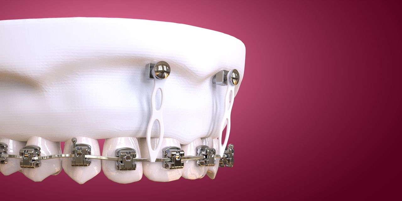 OHI-S Microimplant Anchorage in Clinical Practice Guide for Beginners and Intermediate