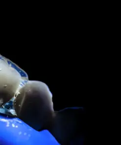 OHI-S Occlusion-driven stress-reduced direct composite (SRDC)