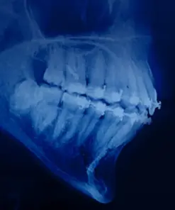 OHI-S Orthodontic treatment in patients with periodontal and alveolar bone pathology