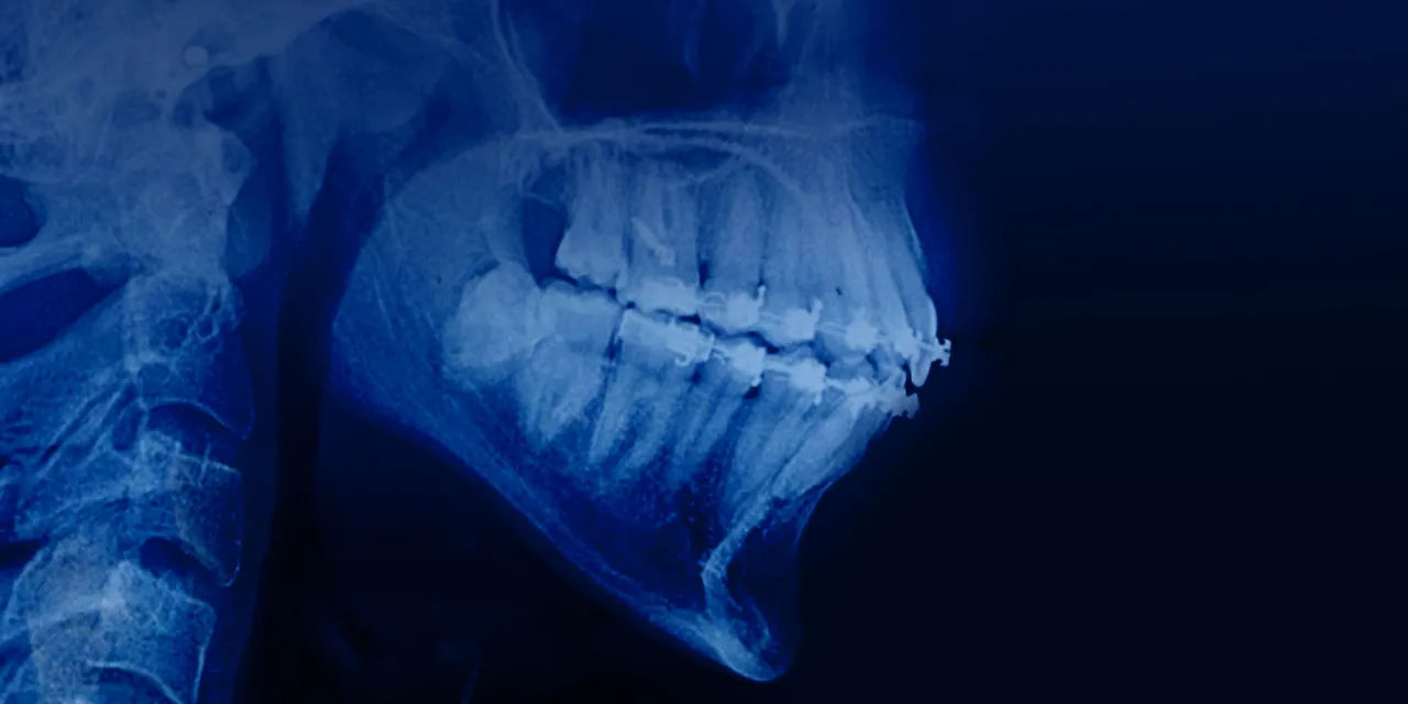 OHI-S Orthodontic treatment in patients with periodontal and alveolar bone pathology OHI-S Orthodontic treatment in patients with periodontal and alveolar bone pathology