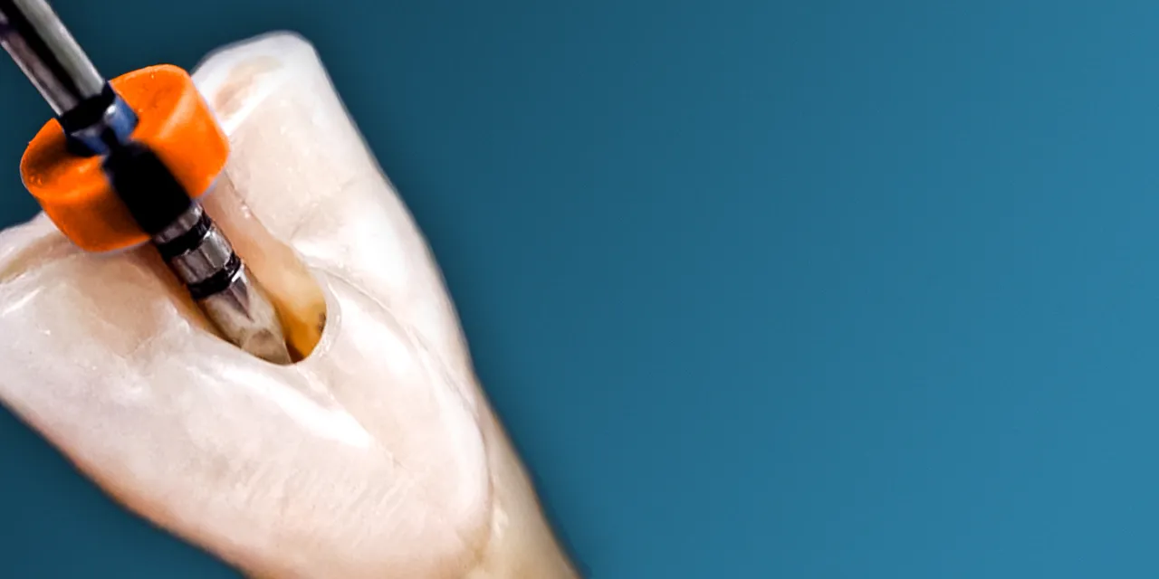 OHI-S Root perforations – diagnosis and treatment OHI-S Root perforations – diagnosis and treatment