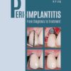 Peri-Implantitis: From Diagnosis to Treatment (EPUB)