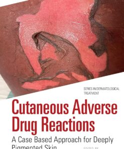Cutaneous Adverse Drug Reactions: A Case Based Approach for Deeply Pigmented Skin (Series in Dermatological Treatment) (PDF)