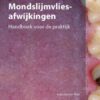 Mondslijmvliesafwijkingen (EPUB)