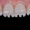 OHI-S Ceramic restorations veneers, inlays, crowns 4 lessons 6h 11m