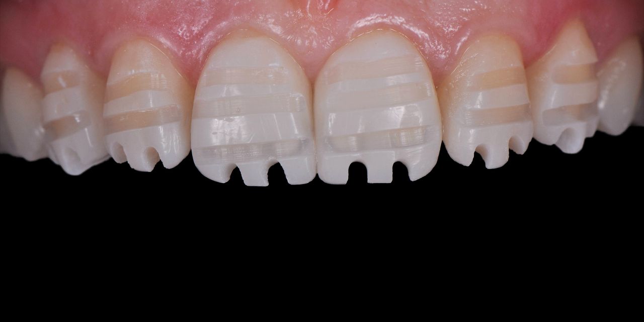 OHI-S Ceramic restorations veneers, inlays, crowns 4 lessons 6h 11m OHI-S Ceramic restorations veneers, inlays, crowns 4 lessons 6h 11m