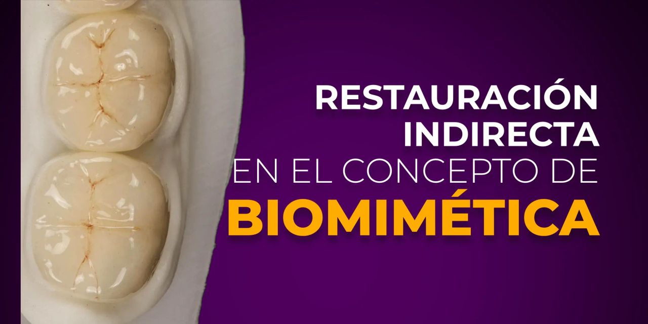 OHI-S Restauración indirecta en el concepto de biomimética Spanish