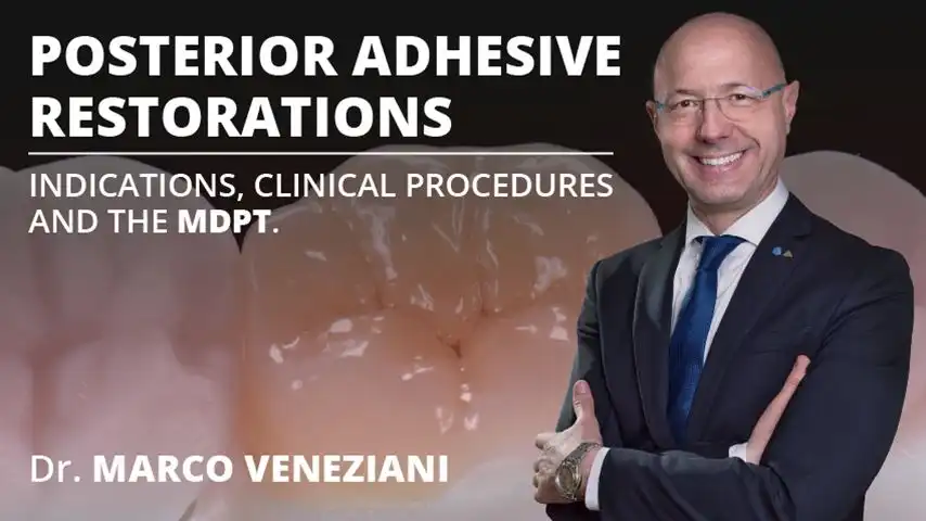 Osteocom Posterior adhesive restorations indications, clinical procedures and mDPT techniques