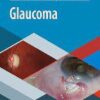 Glaucoma (Spanish Edition) (PDF)