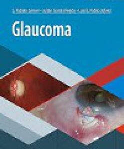 Glaucoma (Spanish Edition) (PDF)