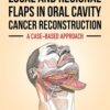 Local and Regional Flaps in Oral Cavity Cancer Reconstruction: A case-based approach (PDF)