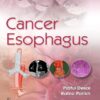 Cancer Esophagus (PDF)