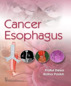 Cancer Esophagus (PDF)