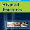 Atypical Fractures (EPUB)