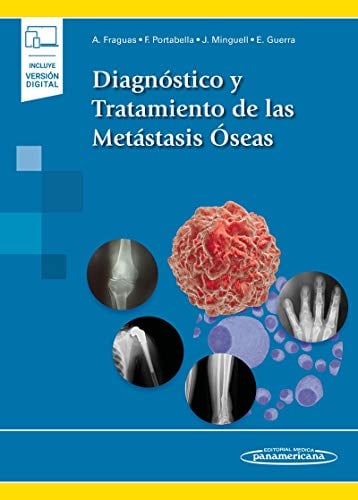 Diagnóstico y Tratamiento de las Metástasis Óseas (PDF) Diagnóstico y Tratamiento de las Metástasis Óseas (PDF)