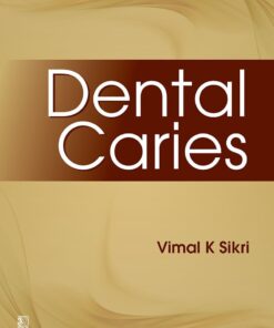 Dental Caries (EPUB)