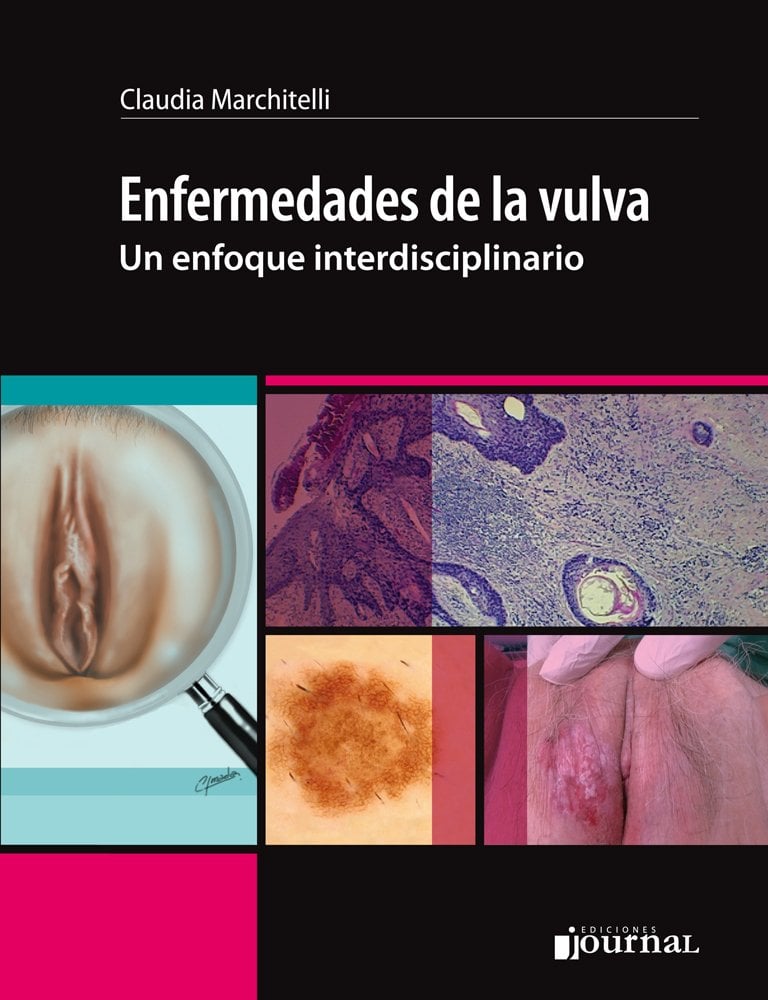 Enfermedades de la vulva- un enfoque interdisciplinario (PDF) Enfermedades de la vulva- un enfoque interdisciplinario (PDF)