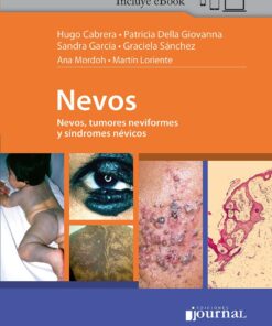 Nevos, Tumores Neviformes y Síndromes Névicos (PDF)