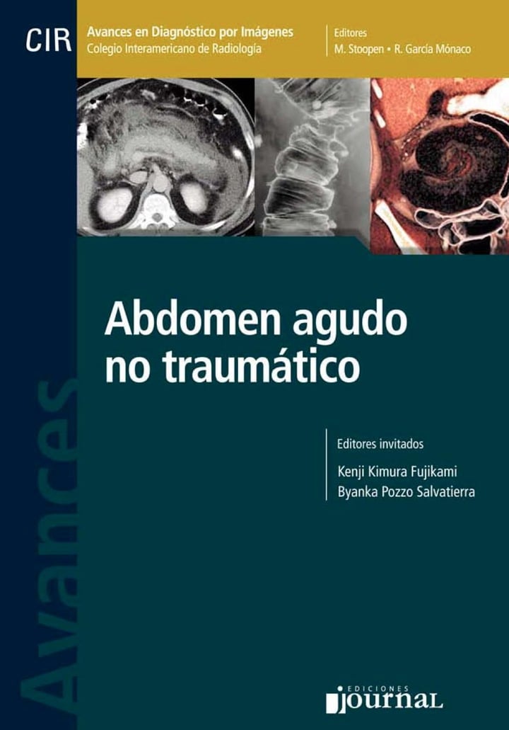 Avances En Diag. Por Imágenes Nº 13: Abdomen Agudo No Traumático (PDF) Avances En Diag. Por Imágenes Nº 13: Abdomen Agudo No Traumático (PDF)