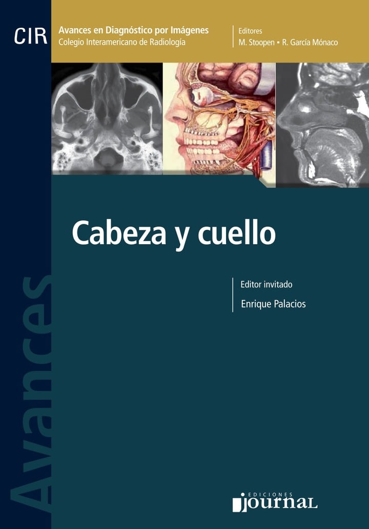 Avances En Diagnostico Por Imágenes Nº 9: Cabeza Y Cuello (PDF) Avances En Diagnostico Por Imágenes Nº 9: Cabeza Y Cuello (PDF)