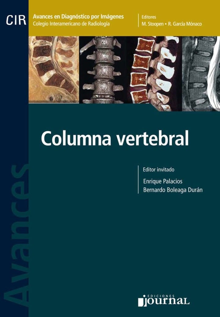 Avances En Diagnostico Por Imágenes Nº 10: Columna Vertebral (PDF) Avances En Diagnostico Por Imágenes Nº 10: Columna Vertebral (PDF)