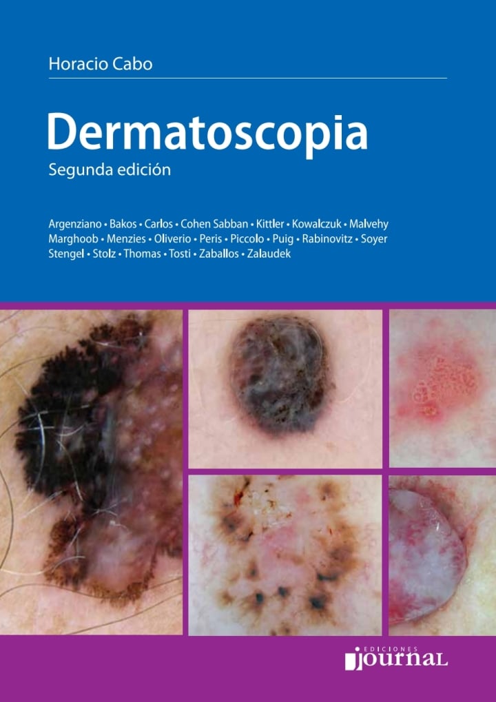 Dermatoscopia, 2nd Edition (PDF) Dermatoscopia, 2nd Edition (PDF)